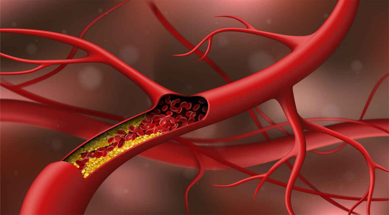 Arteria bloqueada pelo colestrol. Imagem ilustrativa